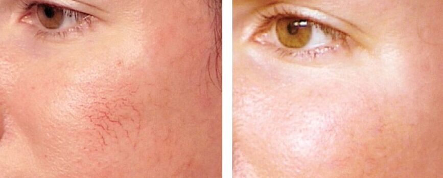 Rosacea Elimination