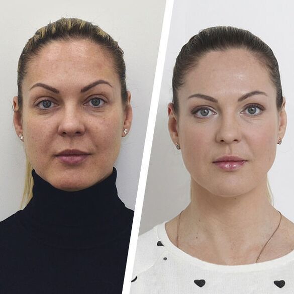 Vor und nach der Gesichtshautverjüngung ohne Operation.