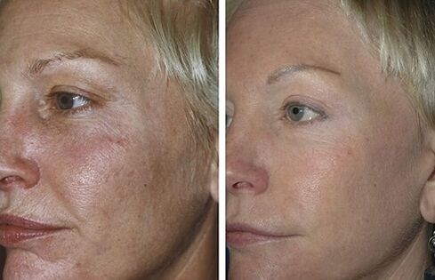 fraktionierte Laser-Oberflächenerneuerung vor und nach Fotos