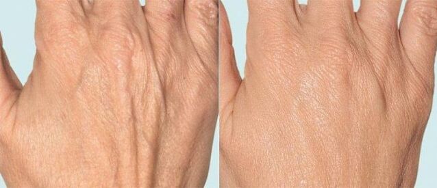 Handhaut vor und nach der fraktionierten Therapie.