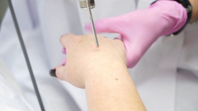 Laser-Handhautverjüngung