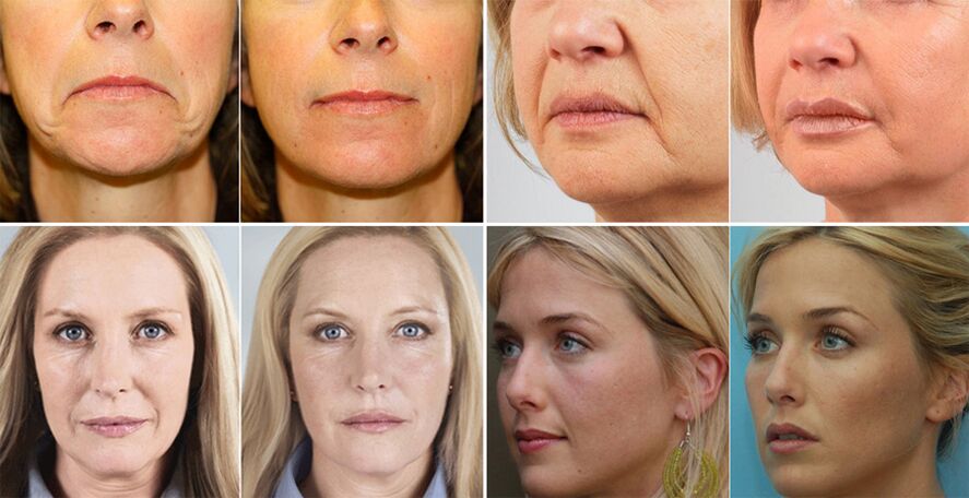Fotos von Frauen vor und nach der Gesichtshautverjüngung